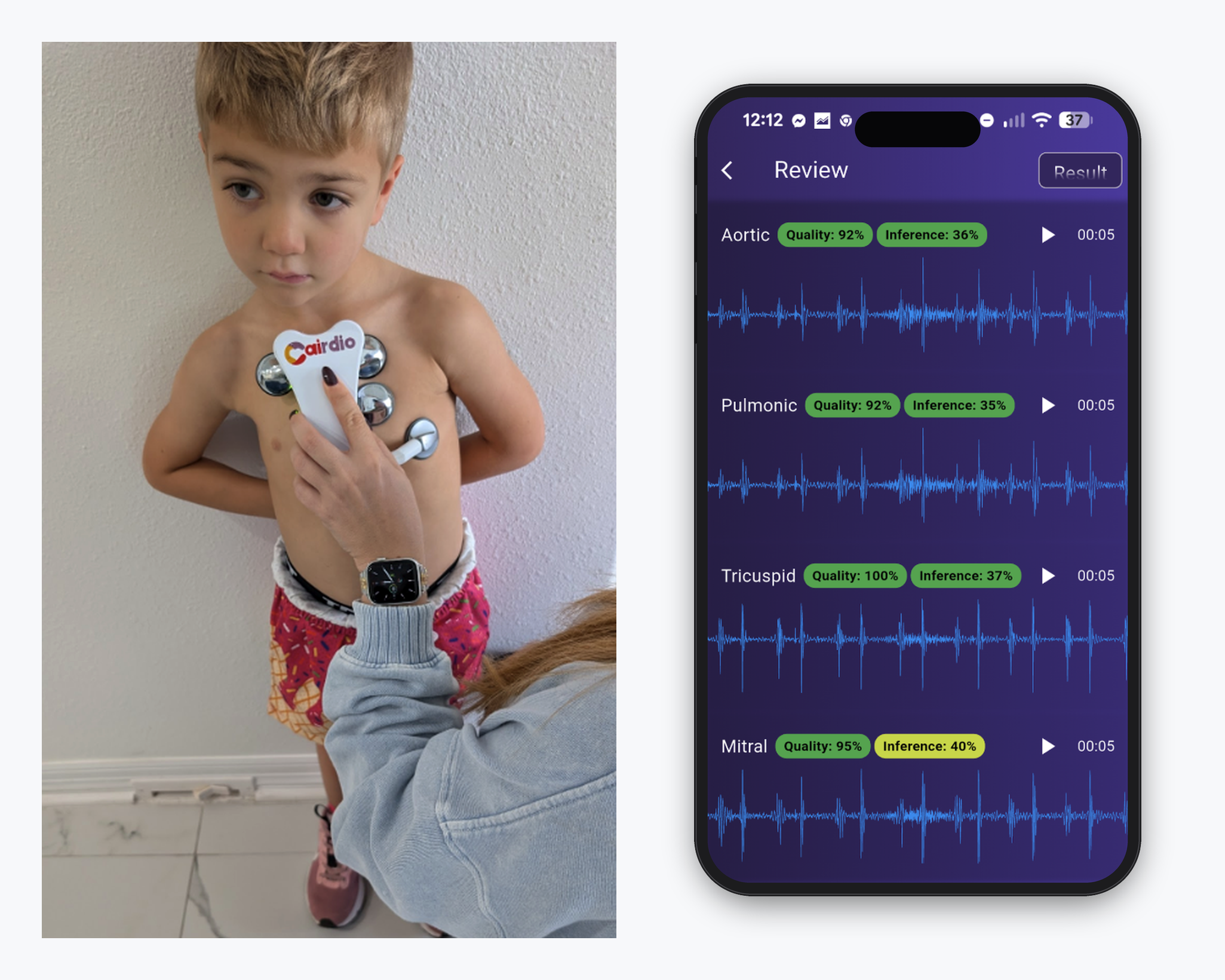 Cairdio device used during a pediatric risk assessment with AI review displayed on-screen